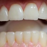 Стоимость протезирования зубов - фото