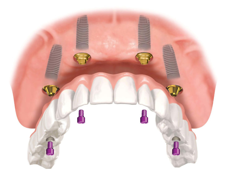 Имплантация зубов - фото