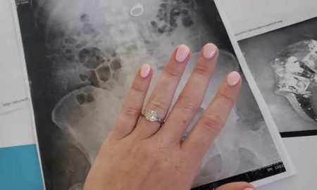 Девушка случайно проглотила обручальное кольцо во сне - фото