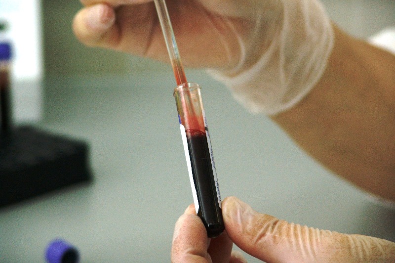 Анализ крови ,Мононуклеоз - фото