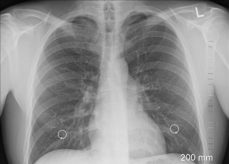 Рентген легких - фото